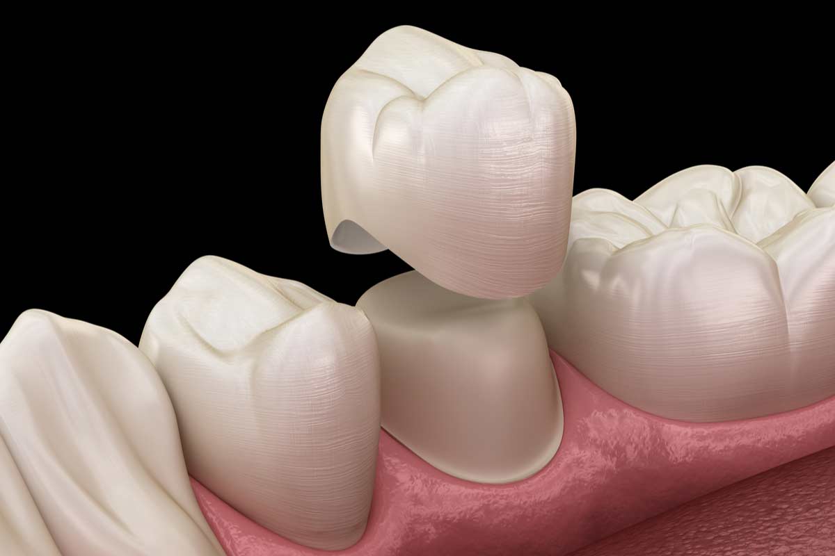 Tijuana Dental crowns | Dental Crowns in Tijuana | An Image of White Teeth