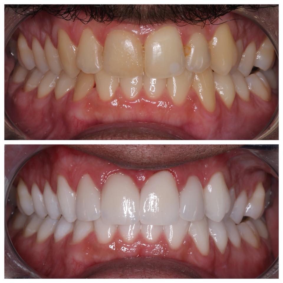 Teeth Whitening in Tijuana, Mexico