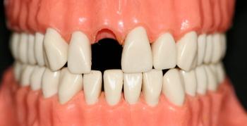 a picture of teeth of a candidate for dental bridge