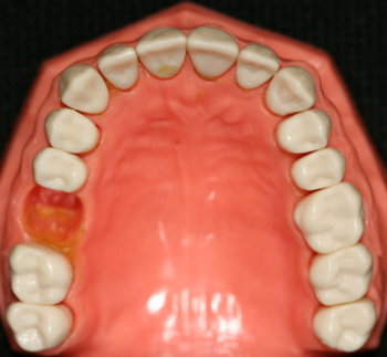 another picture of teeth of a candidate for dental bridges