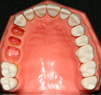 another picture of teeth of a candidate for dental bridge