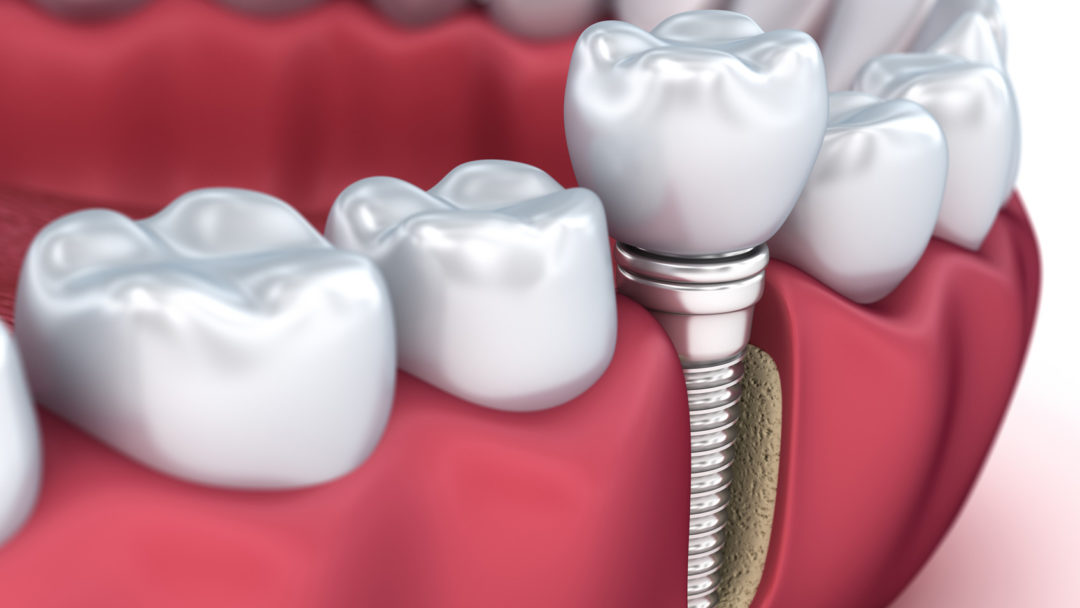 Dental Implants in Tijuana - Dr. Alexander Bartell