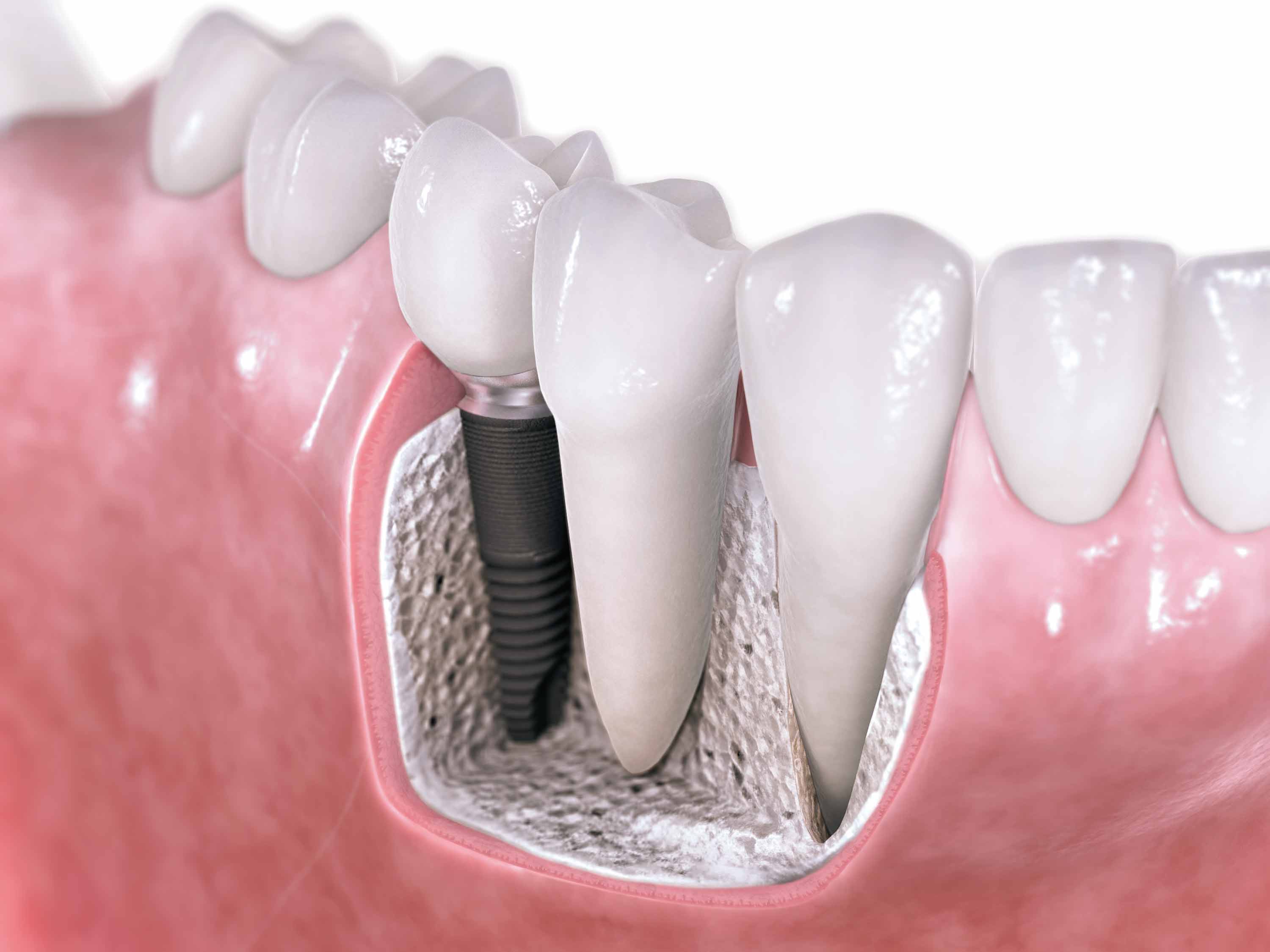 Dental Implants Tijuana Procedure image