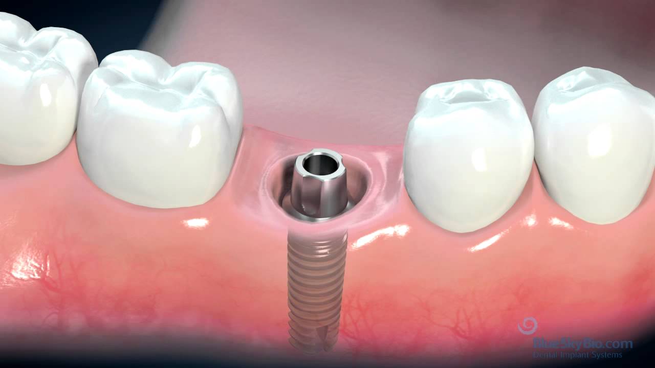 Image of Dental Implants Procedure
