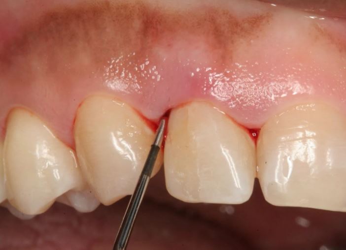 Periodontics in Tijuana