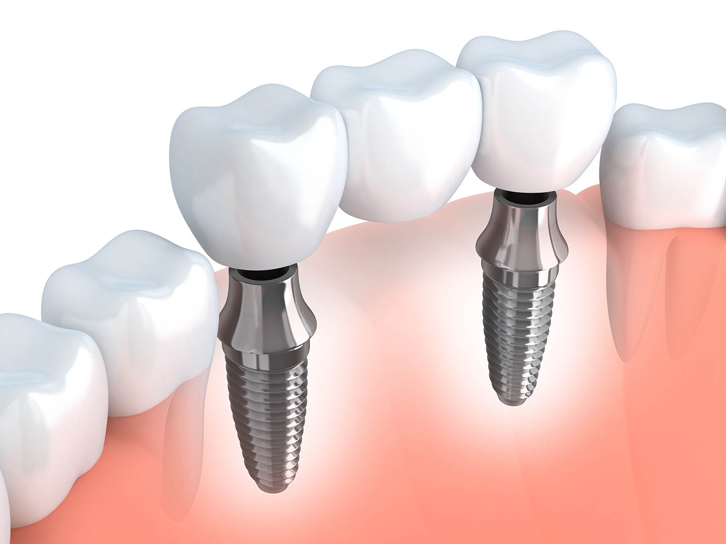 Dental Implants in Tijuana | Procedure 