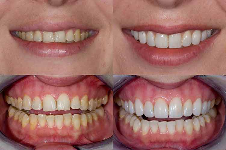 Tijuana Dental Veneers